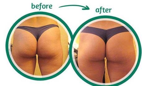 Easy Cellulite Treatments to Get Cellulite Free Skin Cellulite Treatments