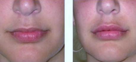 Lip Augmentation
