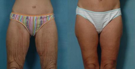 Thigh Lift Surgery Before & After