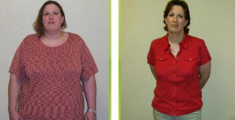 Bariatric Surgery Before & After