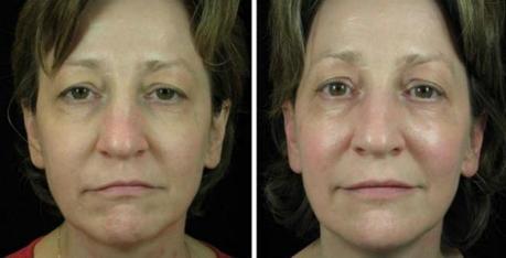 Thermage Before & After