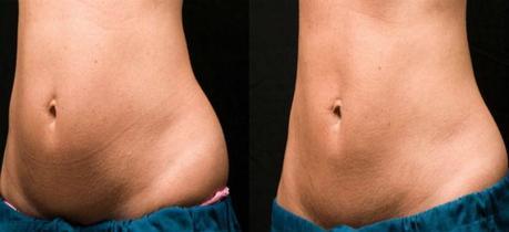 coolsculpting before and after coolsculpting before and after