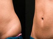 Down Body with Zeltiq Coolsculpting