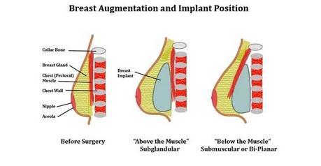 breast implant position