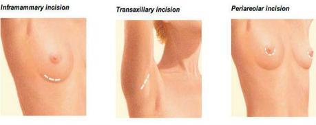 breast implant incision location