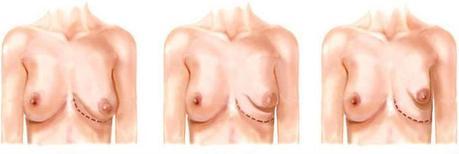 Tuberous Breast Correction Surgery