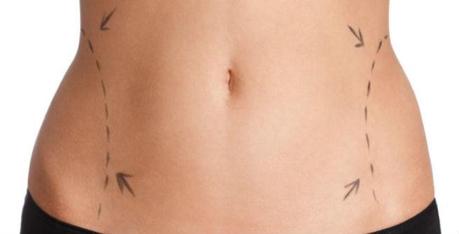 Laser and Ultrasound Assisted Liposuction
