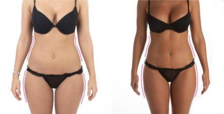 Laser and Ultrasound Assisted Liposuction Before & After