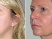 Facial Liposuction ‘Fabby Chick’ from ‘Chubby Cheeks’