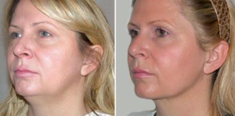 Facial Liposuction Before & After