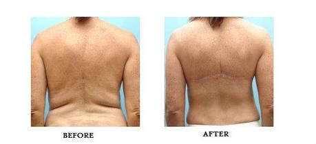 bra line back lift before after