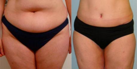 LipoDissolve Before & After
