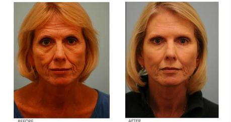 Fat Filler Injection - Before & After