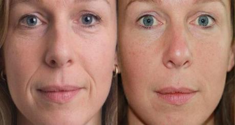 Cosmetic Dermal Fillers Before & After
