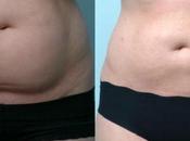 Know Everything About Tumescent Liposuction