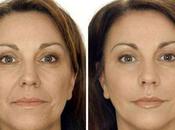 Xeomin Botox Which Better Option You?