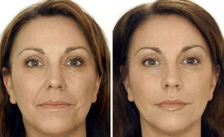 Botox - Before & After