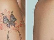 Laser Tattoo Removal Cost, Risks Side Effects