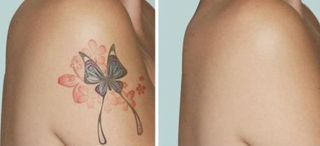 laser tattoo removal cost tattoo collections laser tattoo removal cost tattoo collections