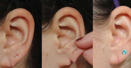 Ear Lobe Surgery Before & After