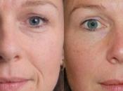 What Should Know About ArteFill Injections