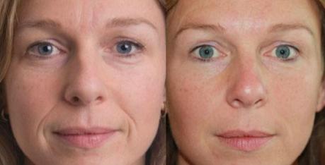 ArteFill Injections Before & After