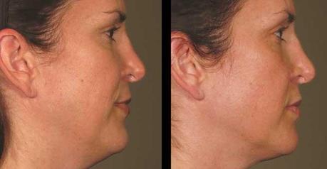 Ultherapy Before & After