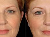 Give Your Skin Beauty Boost With Restylane Injections