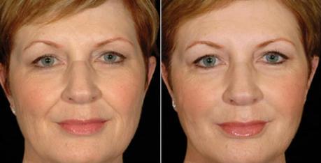 Restylane Injections Before & After