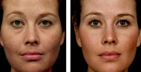 Sculptra Injections Before & After