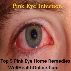 Pink Eye Home Remedies