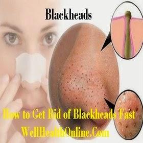 Get Rid of Blackheads