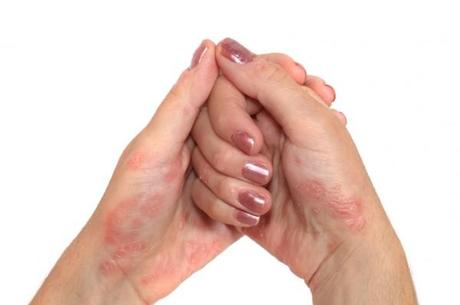 Coping with Psoriasis