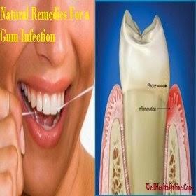 Natural Remedies For Gum Infection