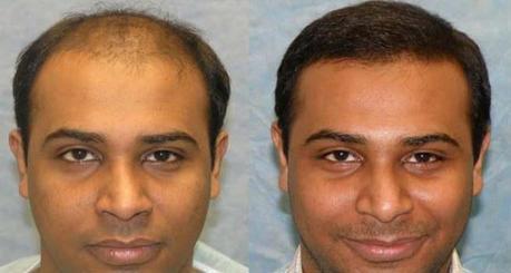 hair transplant surgery before & after