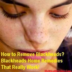 Acne Blackhead Remedy - How to Remove Blackheads - Blackheads Home Remedies That Really Work!