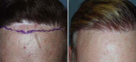 Flap hair transplant Flap hair transplant