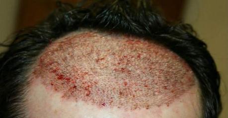 hair transplant graft hair transplant graft