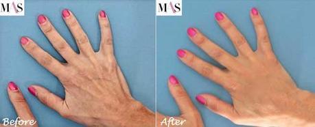 Hand Rejuvenation Treatment