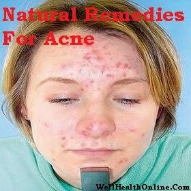 Natural Acne Remedies