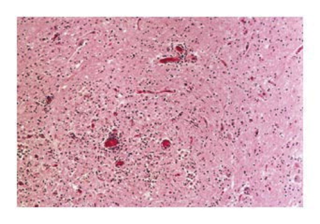 spinal cord section in man with wnv associated polio