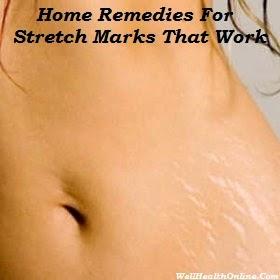 Home Remedies for Stretch Marks That Work