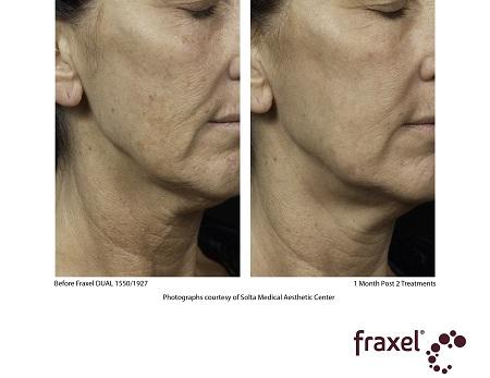 Fraxel Dual Restore – skin radiance at Parkway Medical Hong Kong