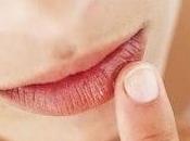 Chapped Lips Causes, Symptoms Treatment