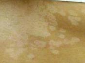 Natural Home Remedies Tinea Versicolor Infection