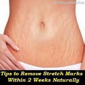 Tips to Remove Stretch Marks