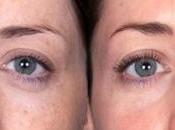 Causes Remedies Chloasma Pregnancy Uncovered