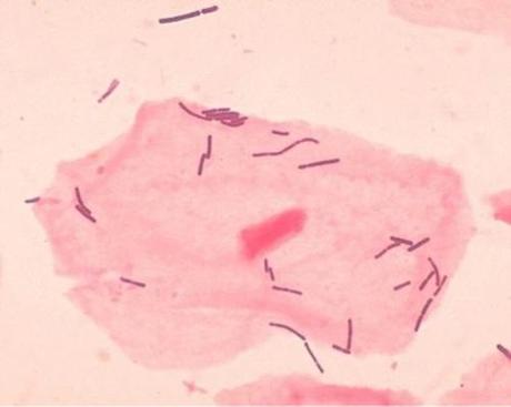 Bacterial vaginosis