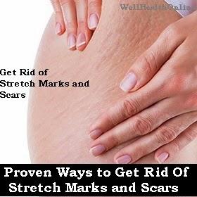 Proven Ways to Get Rid of Stretch Marks and Scars