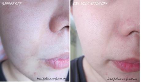 Review: Optimal Pulse Technology OPT by Lumenis OPT 4